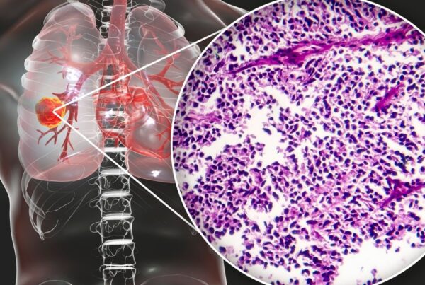 Landscape survey of non-small-cell lung carcinoma (NSCLC) for immuno-oncology (IO)