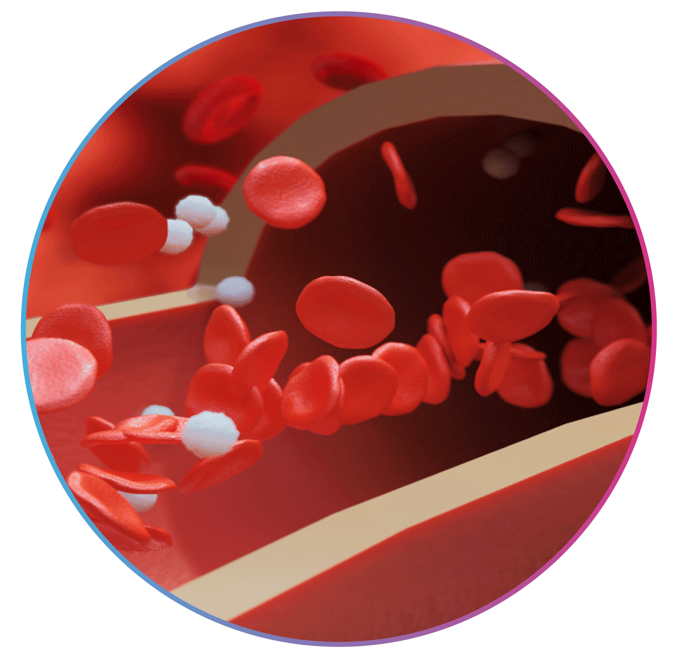 Excelra case study on Rare Monogenic Blood Disorders